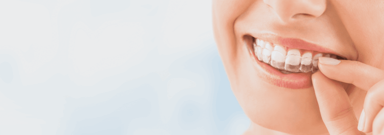 Invisalign Aligners: A Modern Approach to Oral Aesthetics
