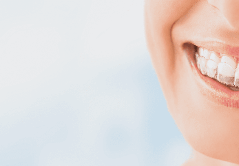 Invisalign Aligners: A Modern Approach to Oral Aesthetics