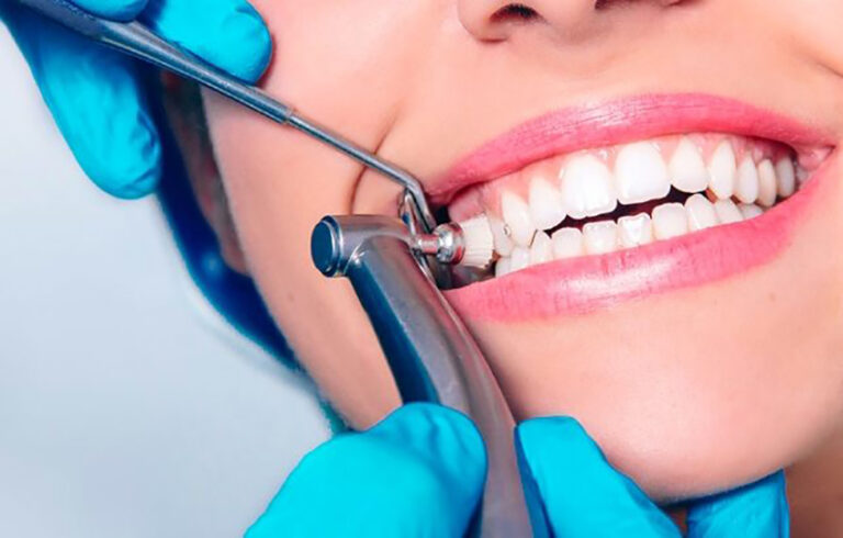 Uncovering the Impact of Composite Bonding on Oral Wellbeing