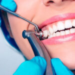 Uncovering the Impact of Composite Bonding on Oral Wellbeing