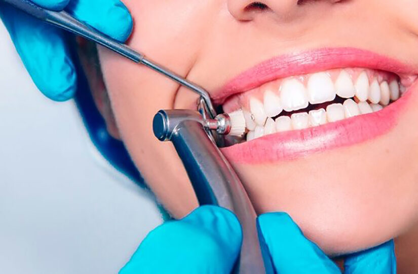 Uncovering the Impact of Composite Bonding on Oral Wellbeing