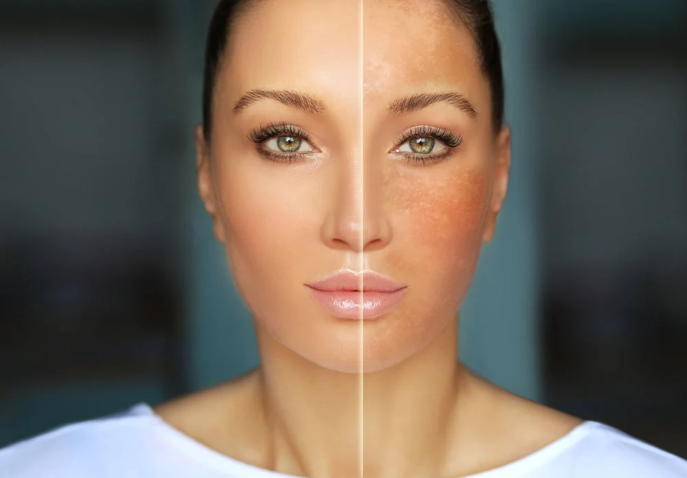 Uneven Skin Tone? Dark Spot Treatments Offer Targeted Care